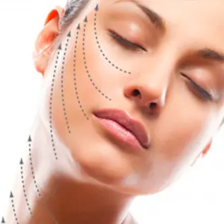 lifting facial com fios de sustentacao